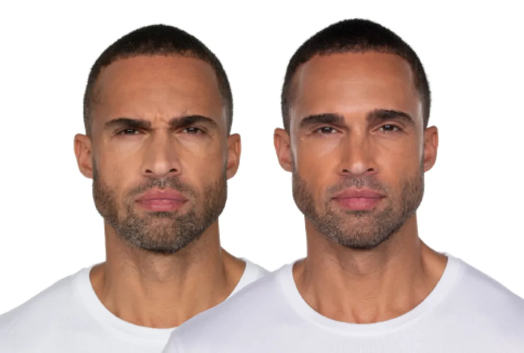 Frown lines before and after Botox treatment