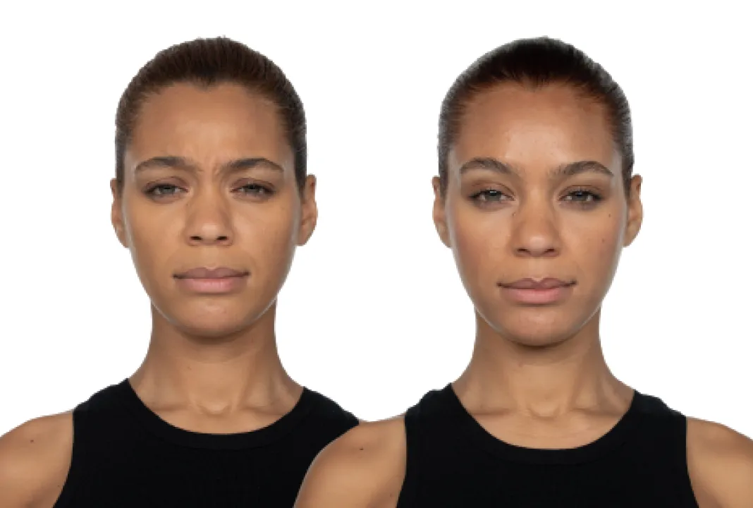 Forehead lines before and after Botox treatment