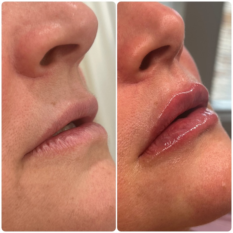 Natural lip enhancement with Revanesse Versa — before and after