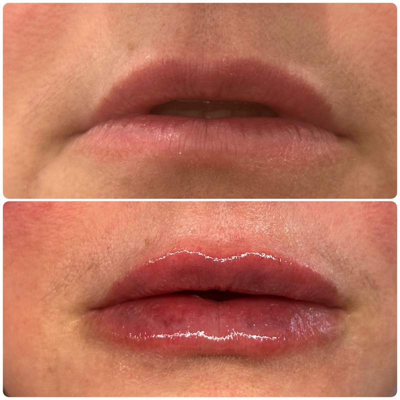Lip filler side profile — Revanesse Versa before and after